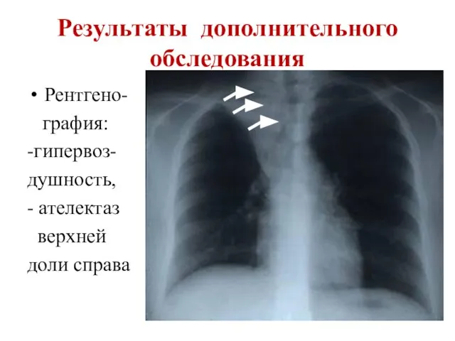 Результаты дополнительного обследования Рентгено- графия: -гипервоз- душность, - ателектаз верхней доли справа