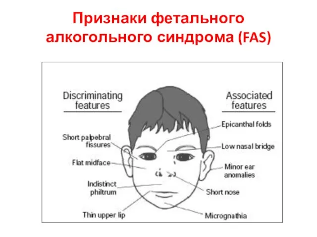 Признаки фетального алкогольного синдрома (FAS)