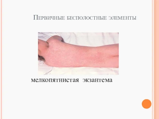 Первичные бесполостные элементы мелкопятнистая экзантема