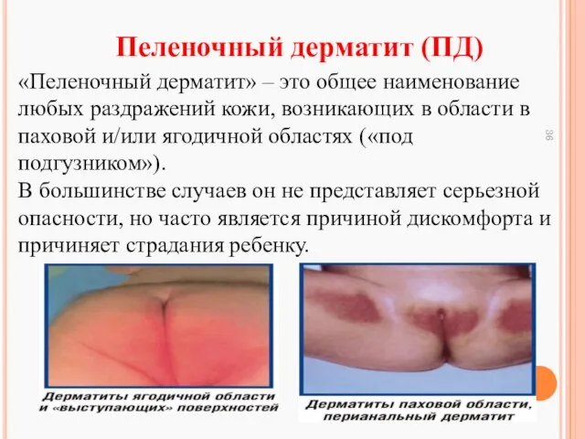 Пеленочный дерматит (ПД) «Пеленочный дерматит» – это общее наименование любых раздражений