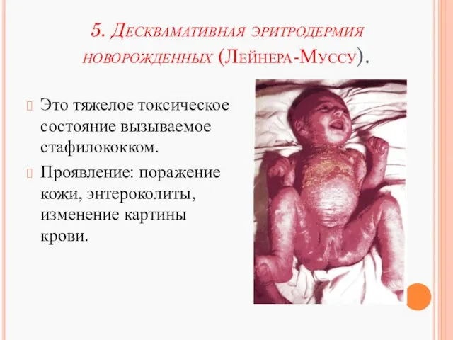 5. Десквамативная эритродермия новорожденных (Лейнера-Муссу). Это тяжелое токсическое состояние вызываемое стафилококком.