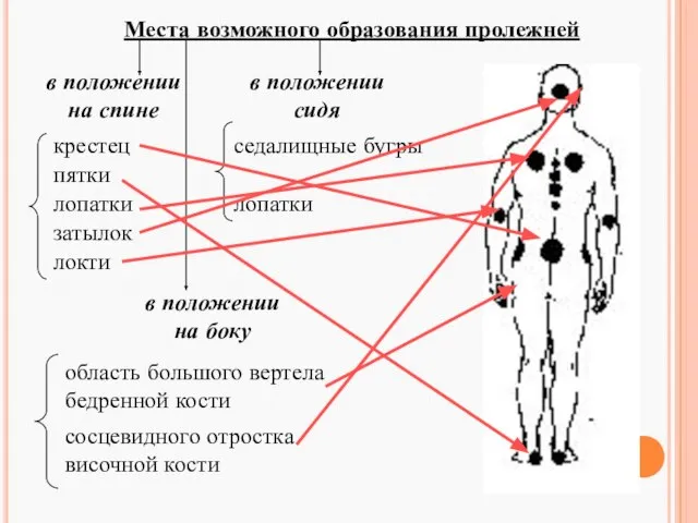 Места возможного образования пролежней в положении на спине в положении сидя