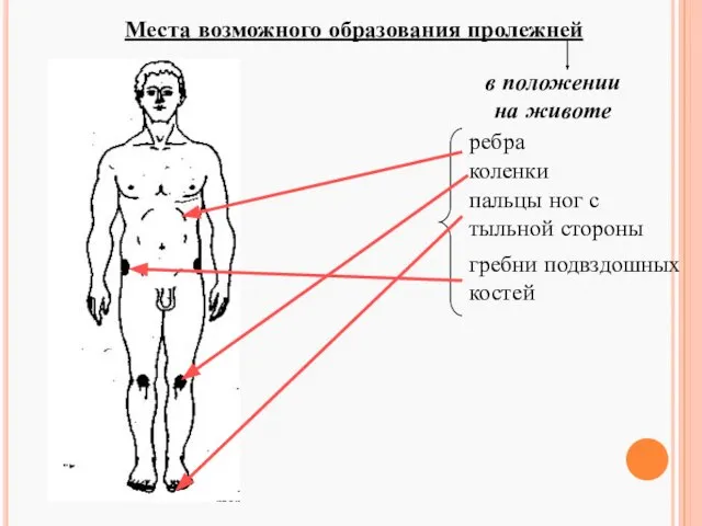 Места возможного образования пролежней в положении на животе ребра коленки пальцы