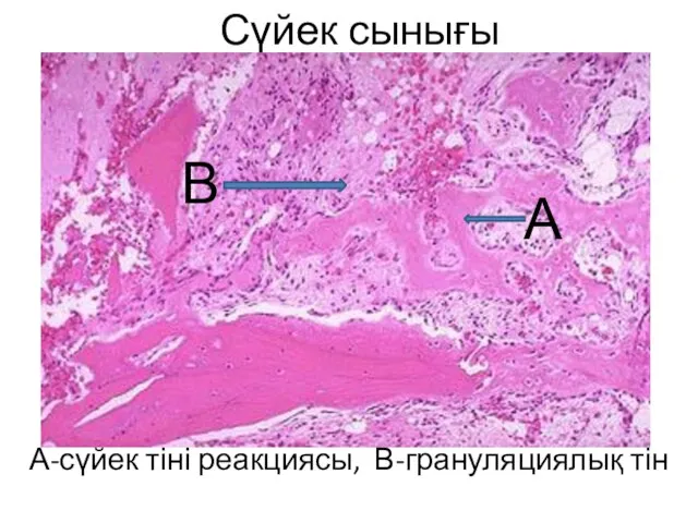 Сүйек сынығы А-сүйек тіні реакциясы, В-грануляциялық тін А В