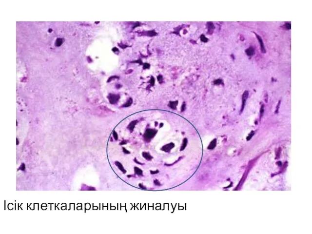 Сүйек хондросаркомасы Ісік клеткаларының жиналуы