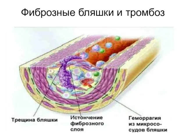Фиброзные бляшки и тромбоз
