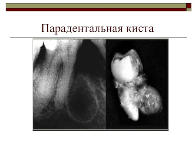 Парадентальная киста