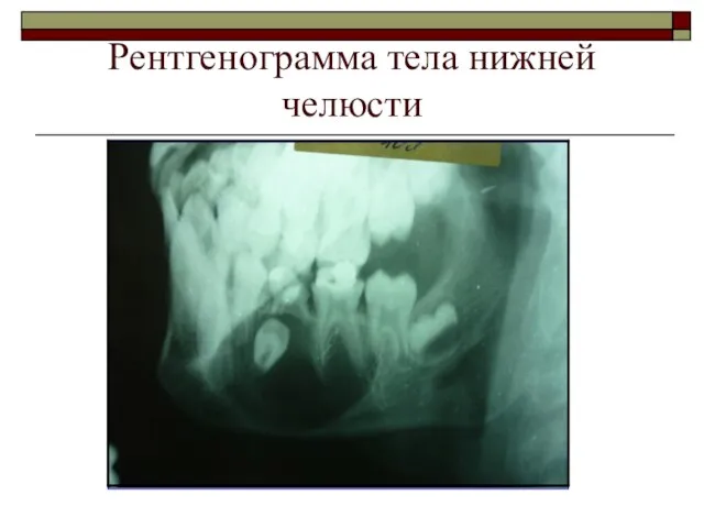 Рентгенограмма тела нижней челюсти