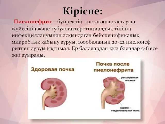 Кіріспе: Пиелонефрит – бүйректің тостағанша-астауша жүйесінің және тубулоинтерстициалдық тінінің инфекциялануынан асқындаған