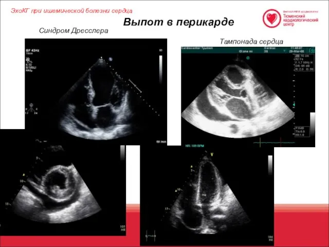 ЭхоКГ при ишемической болезни сердца Выпот в перикарде Синдром Дресслера Тампонада сердца