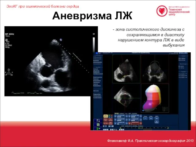 Аневризма ЛЖ ЭхоКГ при ишемической болезни сердца Флакскампф Ф.А. Практическая эхокардиография