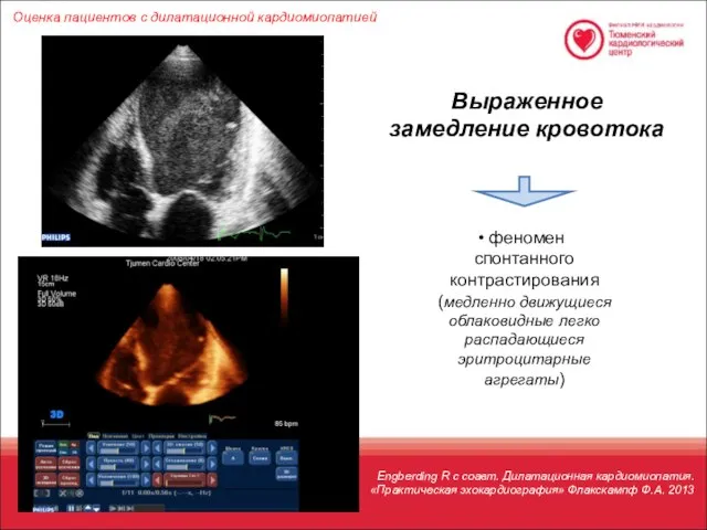 Оценка пациентов с дилатационной кардиомиопатией феномен спонтанного контрастирования (медленно движущиеся облаковидные