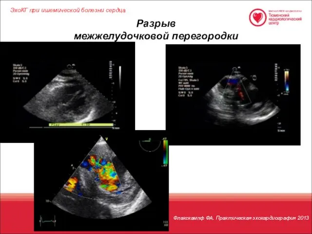 ЭхоКГ при ишемической болезни сердца Разрыв межжелудочковой перегородки Флакскампф ФА. Практическая эхокардиография 2013