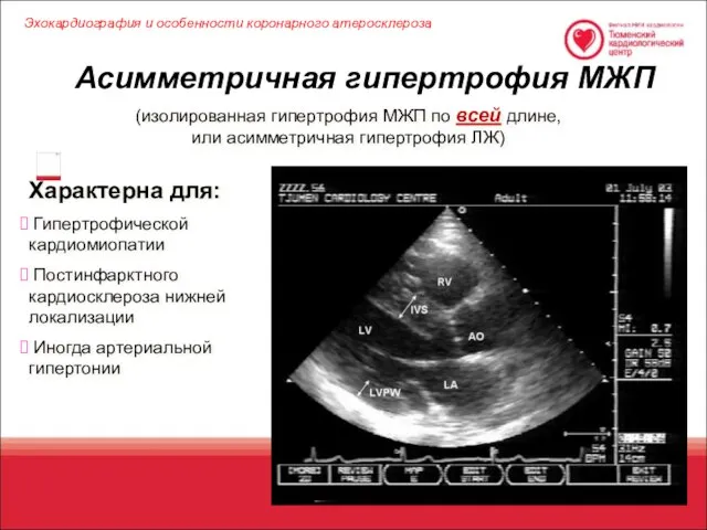 Асимметричная гипертрофия МЖП Характерна для: Гипертрофической кардиомиопатии Постинфарктного кардиосклероза нижней локализации