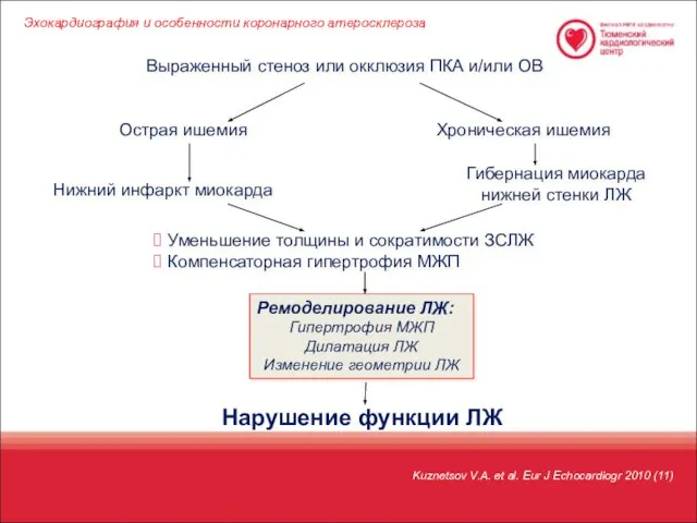 Выраженный стеноз или окклюзия ПКА и/или ОВ Острая ишемия Хроническая ишемия