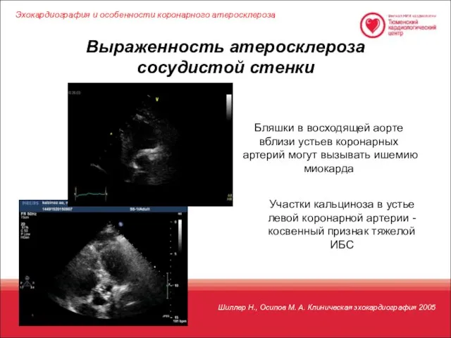 Выраженность атеросклероза сосудистой стенки Шиллер Н., Осипов М. А. Клиническая эхокардиография