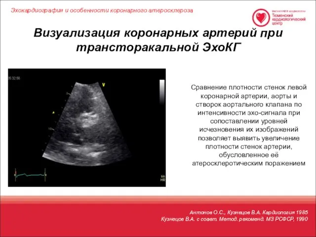 Визуализация коронарных артерий при трансторакальной ЭхоКГ Эхокардиография и особенности коронарного атеросклероза