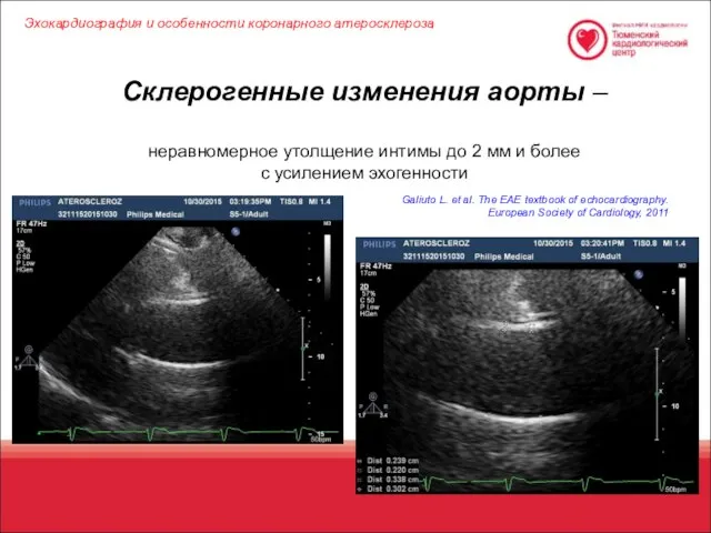 Склерогенные изменения аорты – неравномерное утолщение интимы до 2 мм и