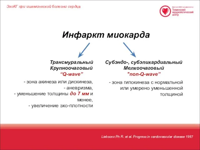 ЭхоКГ при ишемической болезни сердца Трансмуральный Крупноочаговый “Q-wave” зона акинеза или