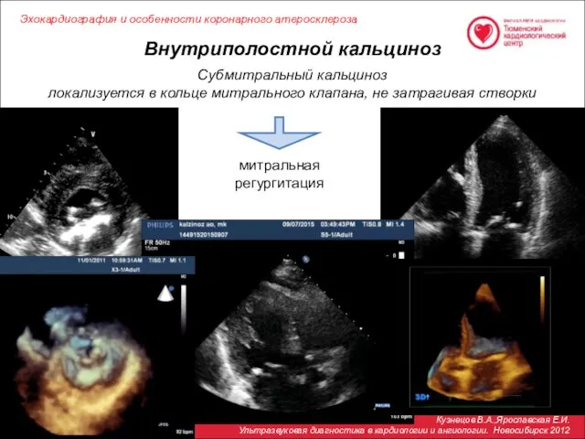 Внутриполостной кальциноз Кузнецов В.А.,Ярославская Е.И. Ультразвуковая диагностика в кардиологии и ангиологии.