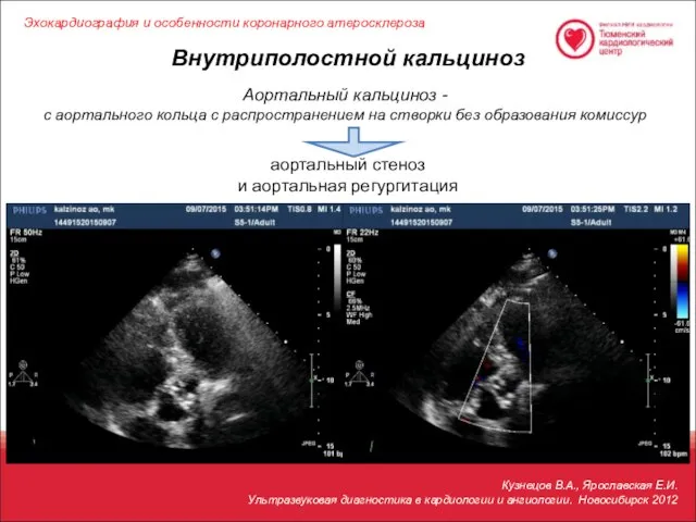 Внутриполостной кальциноз Кузнецов В.А., Ярославская Е.И. Ультразвуковая диагностика в кардиологии и