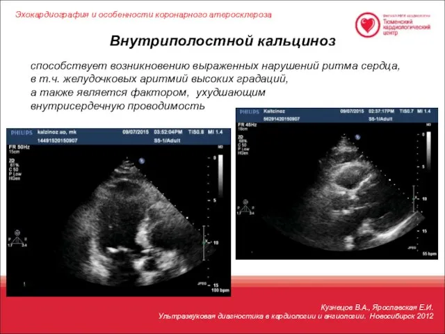 Кузнецов В.А., Ярославская Е.И. Ультразвуковая диагностика в кардиологии и ангиологии. Новосибирск