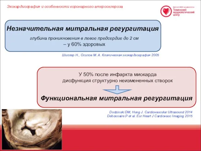 Незначительная митральная регургитация глубина проникновения в левое предсердие до 2 см