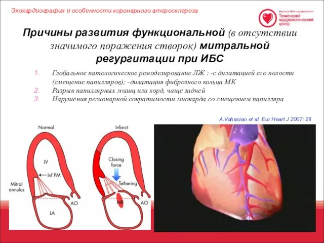 A.Vahanian et al. Eur Heart J 2007; 28 Причины развития функциональной