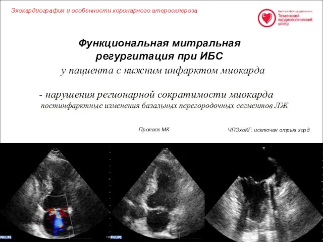 Функциональная митральная регургитация при ИБС - нарушения регионарной сократимости миокарда постинфарктные