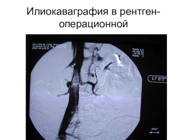 Илиокаваграфия в рентген-операционной