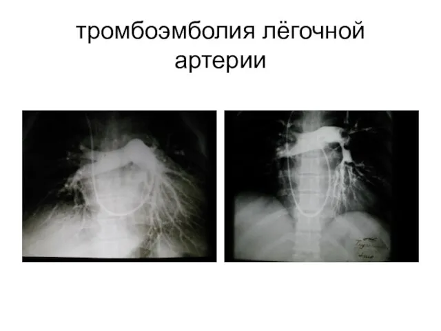 тромбоэмболия лёгочной артерии