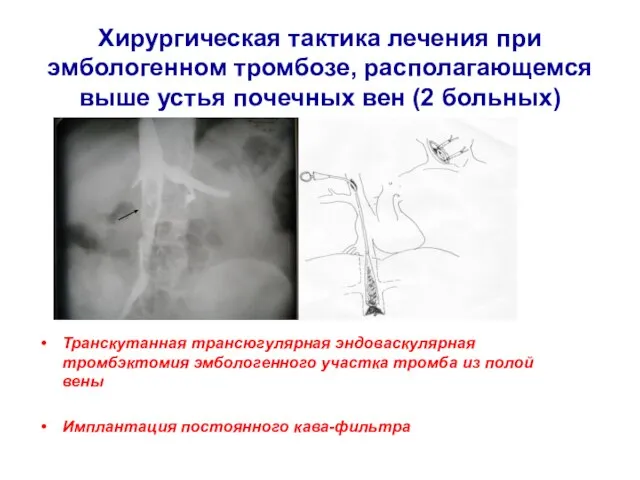 Хирургическая тактика лечения при эмбологенном тромбозе, располагающемся выше устья почечных вен