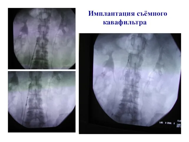 Имплантация съёмного кавафильтра