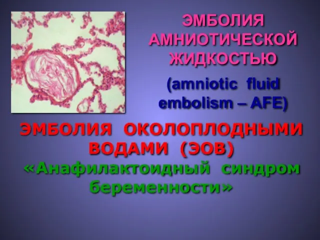 ЭМБОЛИЯ ОКОЛОПЛОДНЫМИ ВОДАМИ (ЭОВ) «Анафилактоидный синдром беременности» (amniotic fluid embolism – AFE) ЭМБОЛИЯ АМНИОТИЧЕСКОЙ ЖИДКОСТЬЮ