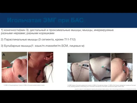 Игольчатая ЭМГ при БАС A. EMG of the genioglossus muscle. B.