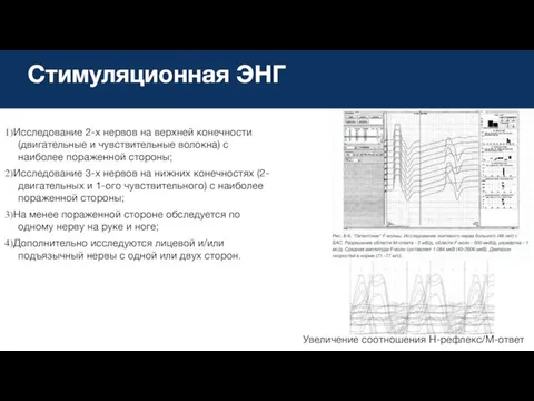 Стимуляционная ЭНГ 1)Исследование 2-х нервов на верхней конечности (двигательные и чувствительные