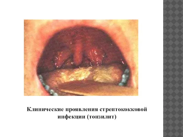 Клинические проявления стрептококковой инфекции (тонзилит)