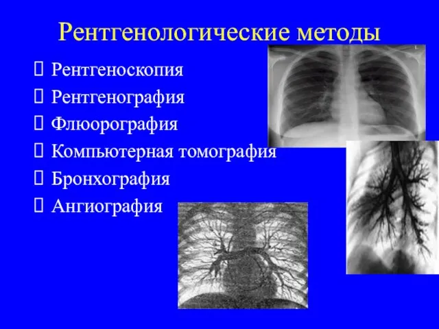 Рентгенологические методы Рентгеноскопия Рентгенография Флюорография Компьютерная томография Бронхография Ангиография