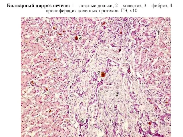 Билиарный цирроз печени: 1 – ложные дольки, 2 – холестаз, 3