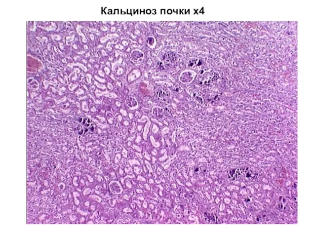 Кальциноз почки х4