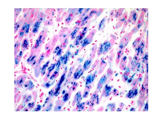 Hemochromatosis of the heart