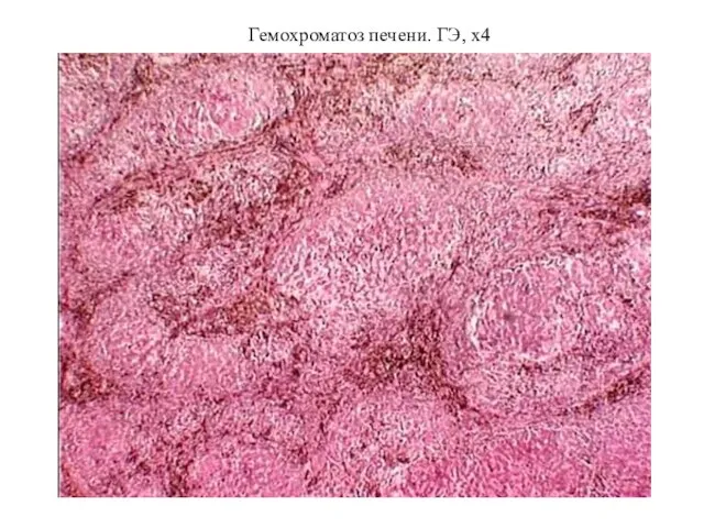 Гемохроматоз печени. ГЭ, х4