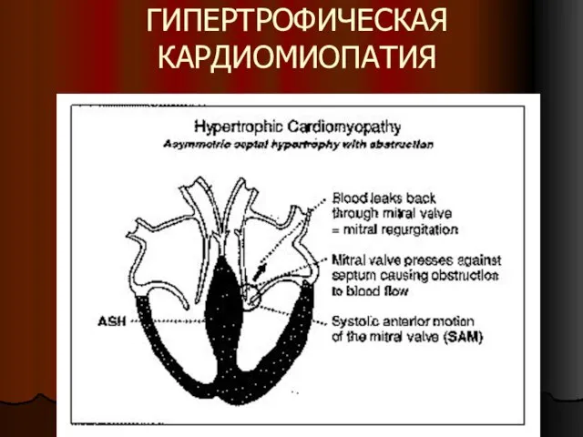 ГИПЕРТРОФИЧЕСКАЯ КАРДИОМИОПАТИЯ