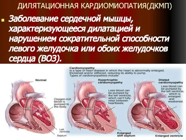 ДИЛЯТАЦИОННАЯ КАРДИОМИОПАТИЯ(ДКМП) Заболевание сердечной мышцы, характеризующееся дилатацией и нарушением сократительной способности