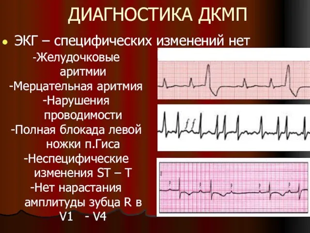 ДИАГНОСТИКА ДКМП ЭКГ – специфических изменений нет -Желудочковые аритмии -Мерцательная аритмия