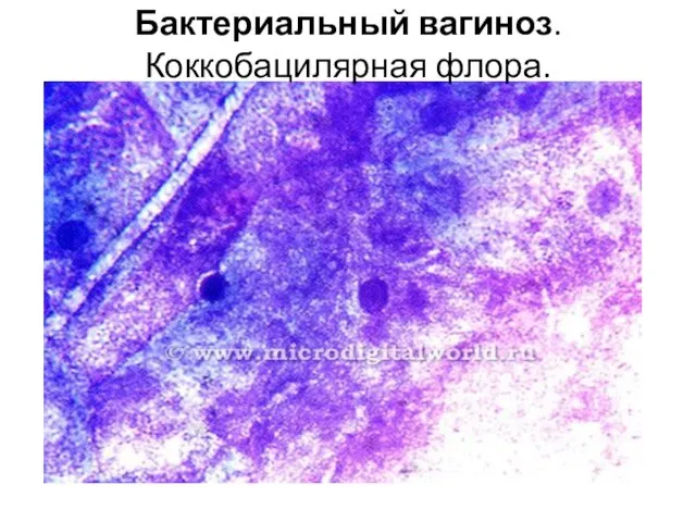 Бактериальный вагиноз. Коккобацилярная флора.
