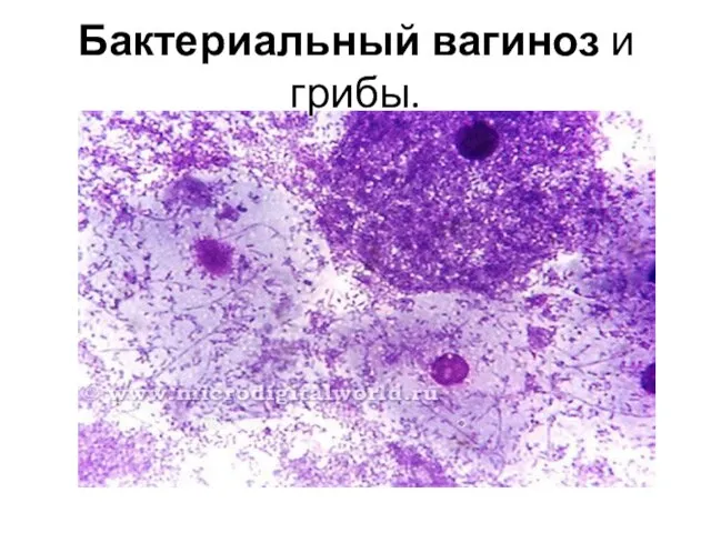 Бактериальный вагиноз и грибы.
