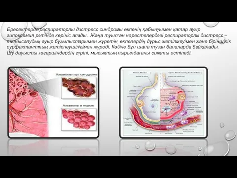 Ересектерде респираторлы дистресс синдромы өкпенің қабынуымен қатар ауыр гипоксемия ретінде көрініс