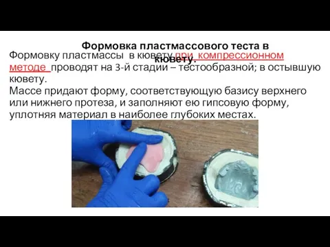 Формовку пластмассы в кювету при компрессионном методе проводят на 3-й стадии