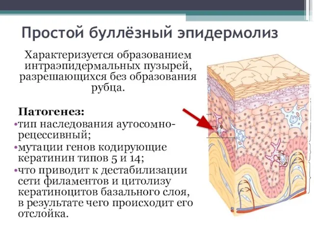 Простой буллёзный эпидермолиз Характеризуется образованием интраэпидермальных пузырей, разрешающихся без образования рубца.